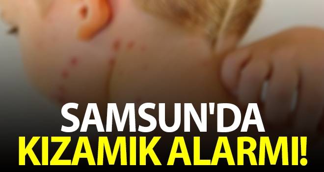 Samsun'da kızamık alarmı